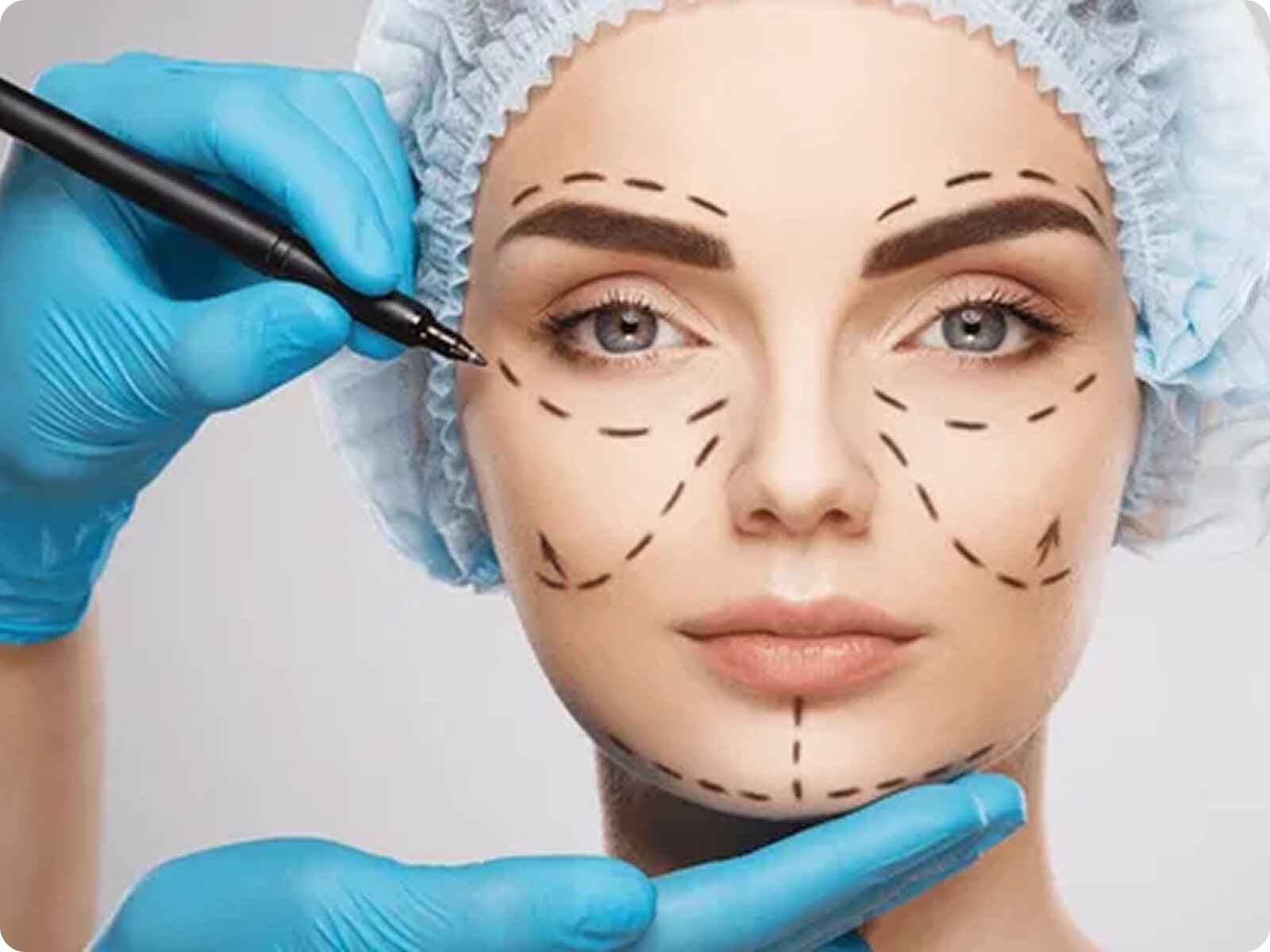A close-up of a woman's face with surgical markup lines, with a surgeon's gloved hands holding a marker.